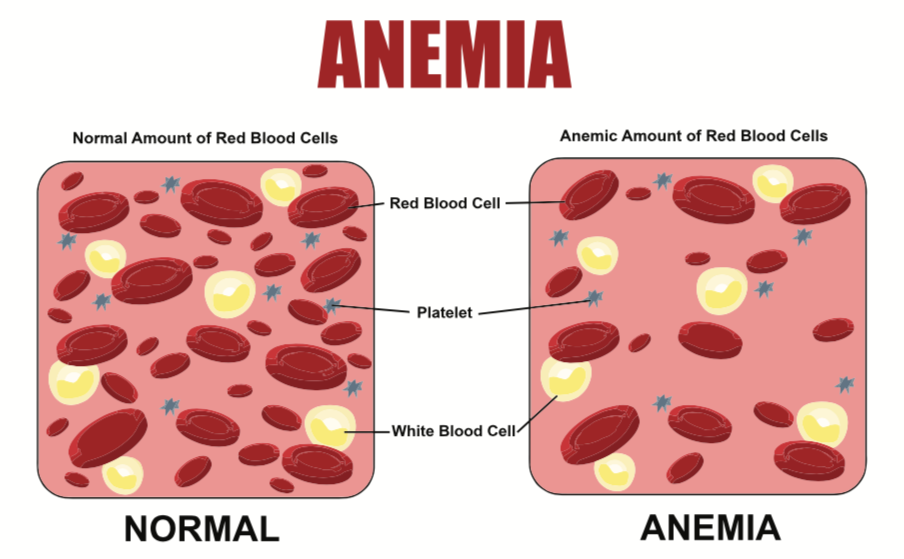 anemia